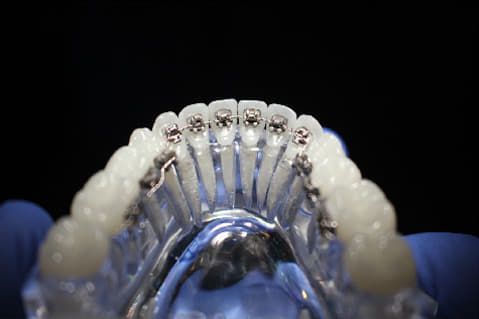 Innenliegende Zahnspange